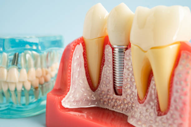 Best Wisdom Tooth Removal  in USA